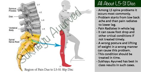 l5 s1 symptoms nerve impingement